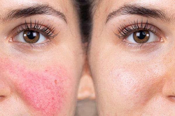 rosacea